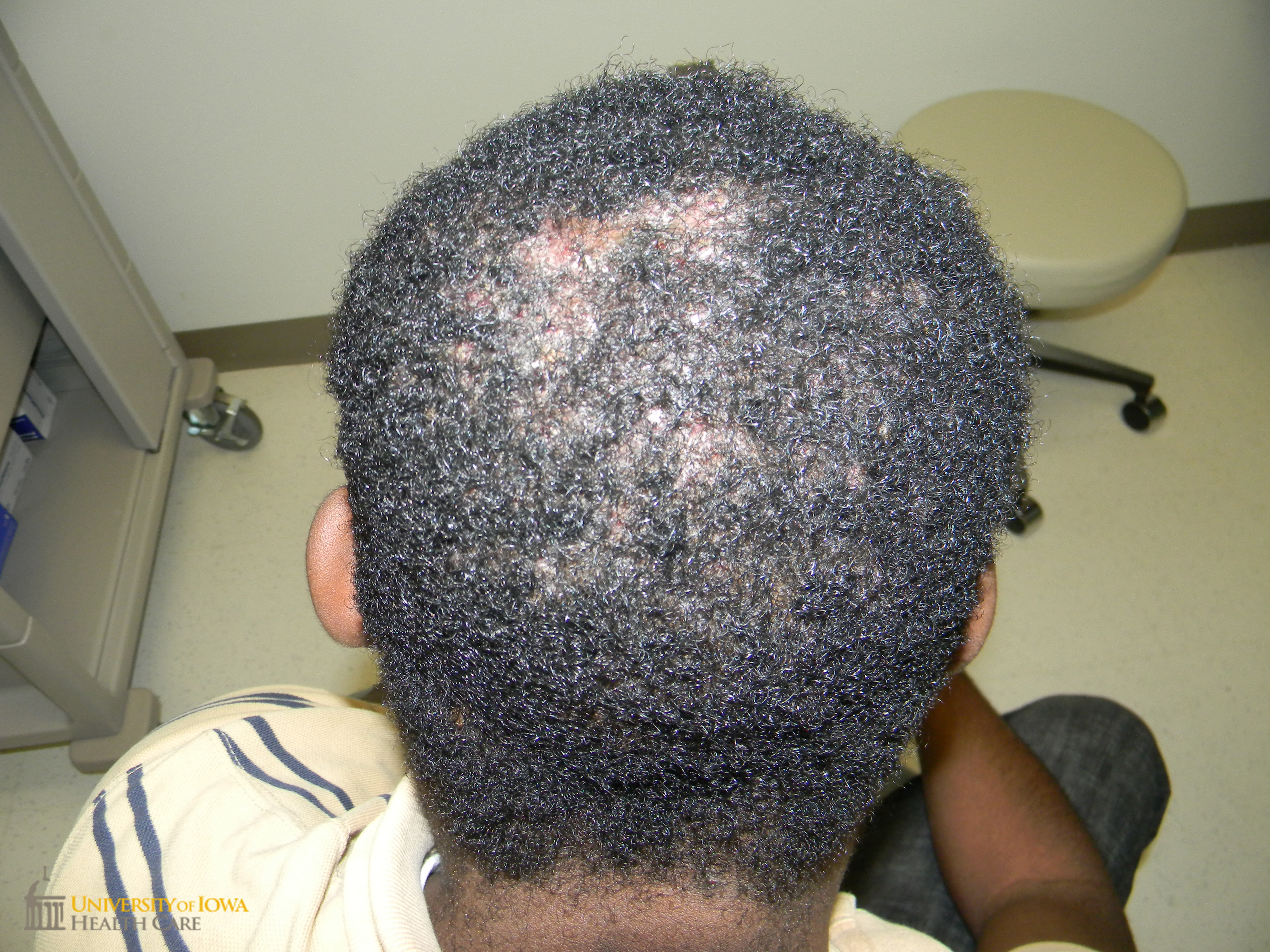 Diffuse confluent keloidal plaques and nodules with associated scaring alopecia on the occipital scalp. (click images for higher resolution).